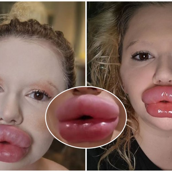 Веќе одбиваат да ја оперираат: „Имам најголеми усни на светот, ама направив нов зафат“