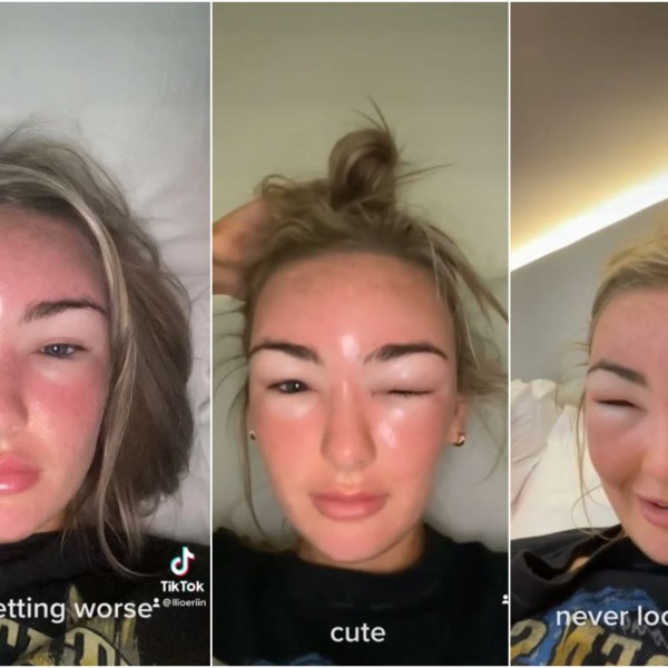 Жена на одмор доживеала екстремно оштетување на лицето поради „труење со сонце“: Ова се предупредувачки симптоми